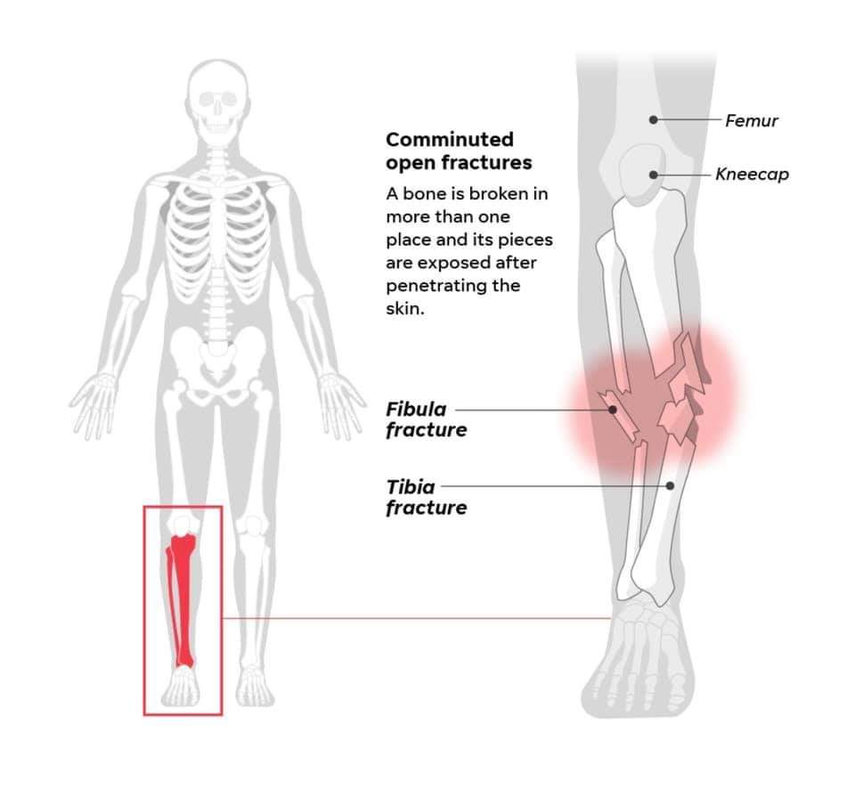 Injuries suffered by Tiger Woods in the accident