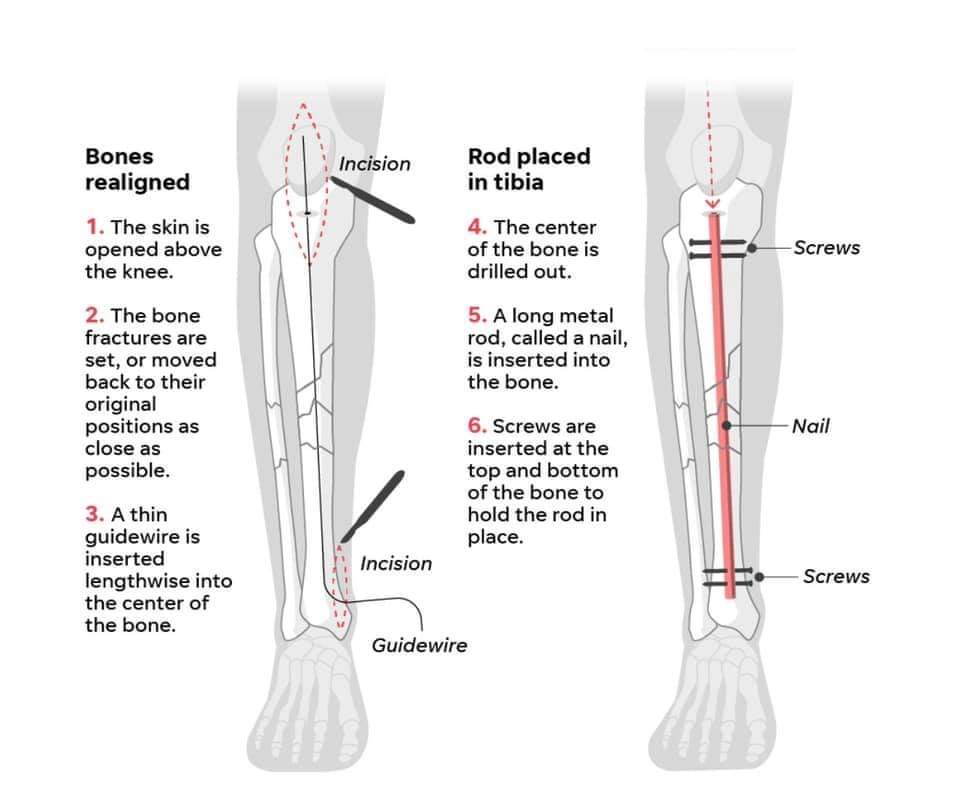 Operations performed on Tiger's legs